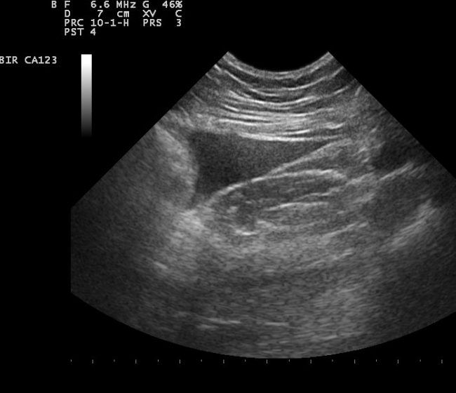 Abdominal_fluid_Ultrasound_110331143034_1433400 Abdominal_fluid_Ultrasound_110331143034_1433400