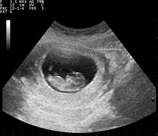 How Much Does An Ultrasound Cost Without Insurance